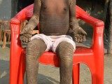 孟加拉小男孩患怪病成石头人 每天门都不敢出